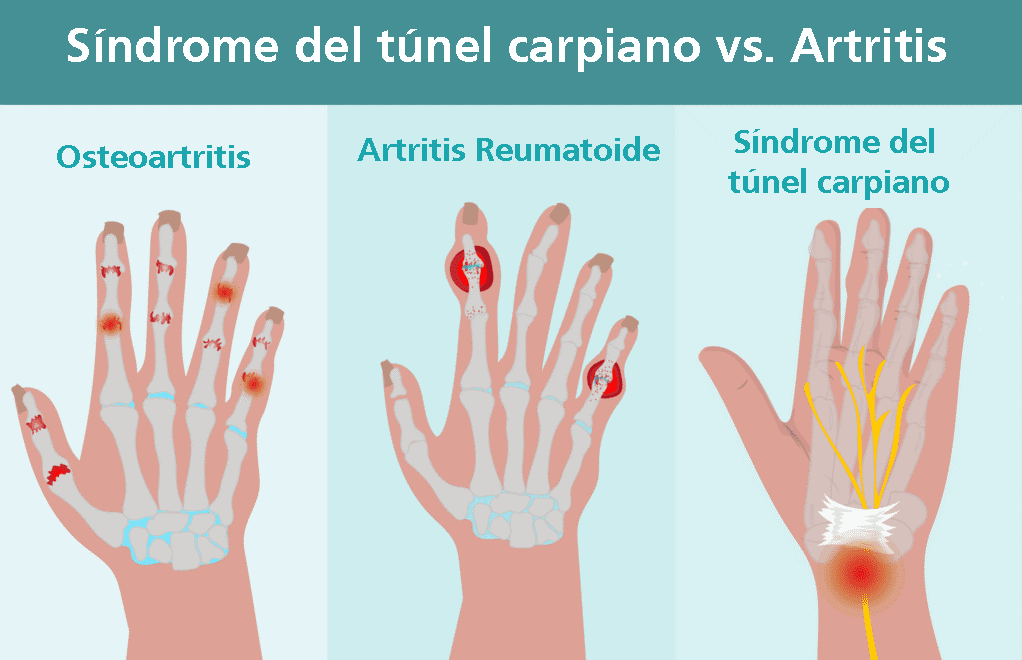 carpal artrosis)