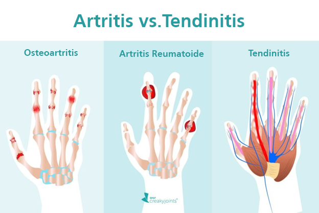 gene reposo Estrecho Artritis Y Tendinitis: ¿Cuál Es La Diferencia? - CreakyJoints